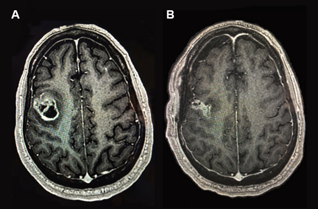 Glioblastoma_before_and_after_complete_resection